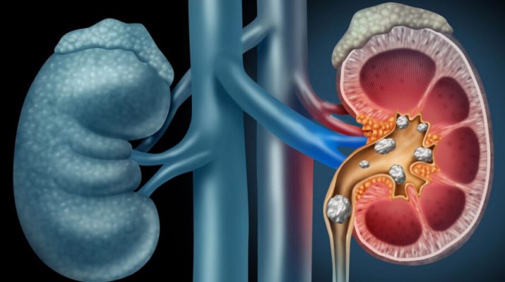 Common Symptoms for Kidney Stones