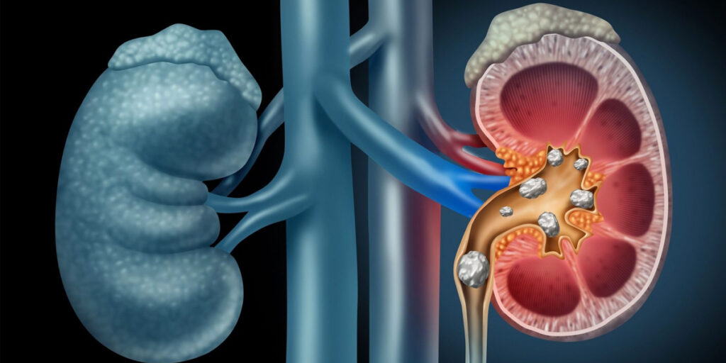 Common Symptoms for Kidney Stones