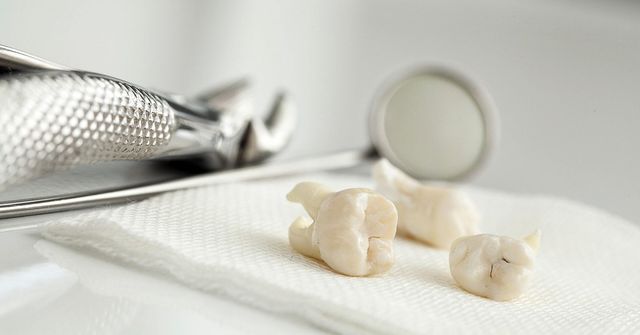 Know About Tooth Extraction and Removal
