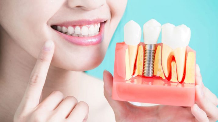 Dental Implants