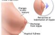 What are the symptoms of breast cancer