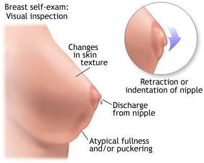 What are the symptoms of breast cancer