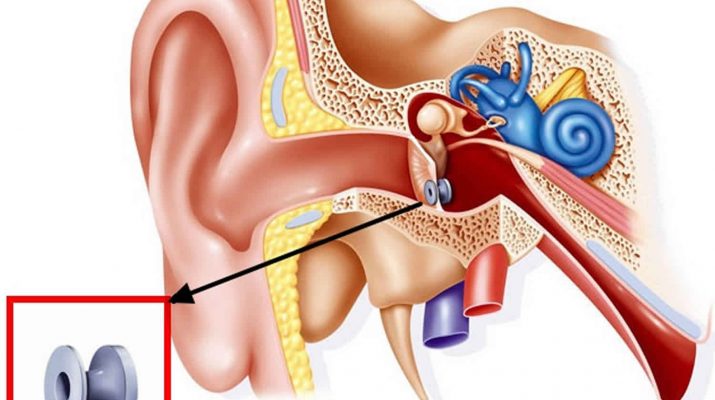 Difference between Myringotomy and Tympanostomy