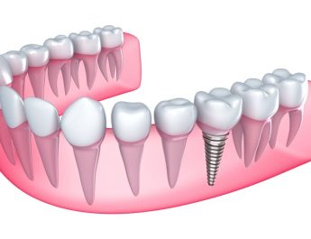 Need To Get A Dental Implant