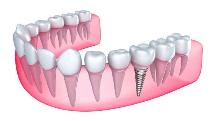 Need To Get A Dental Implant