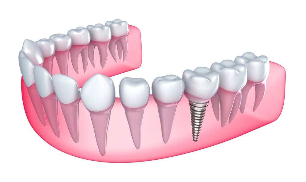 Need To Get A Dental Implant