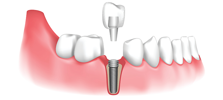 Dental Implants