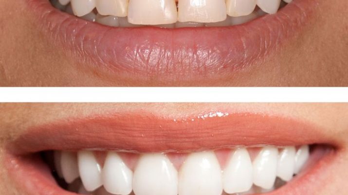 Cosmetic Dentistry Excellence in London
