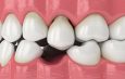 Tooth Replacement Option in Brick