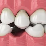 Tooth Replacement Option in Brick