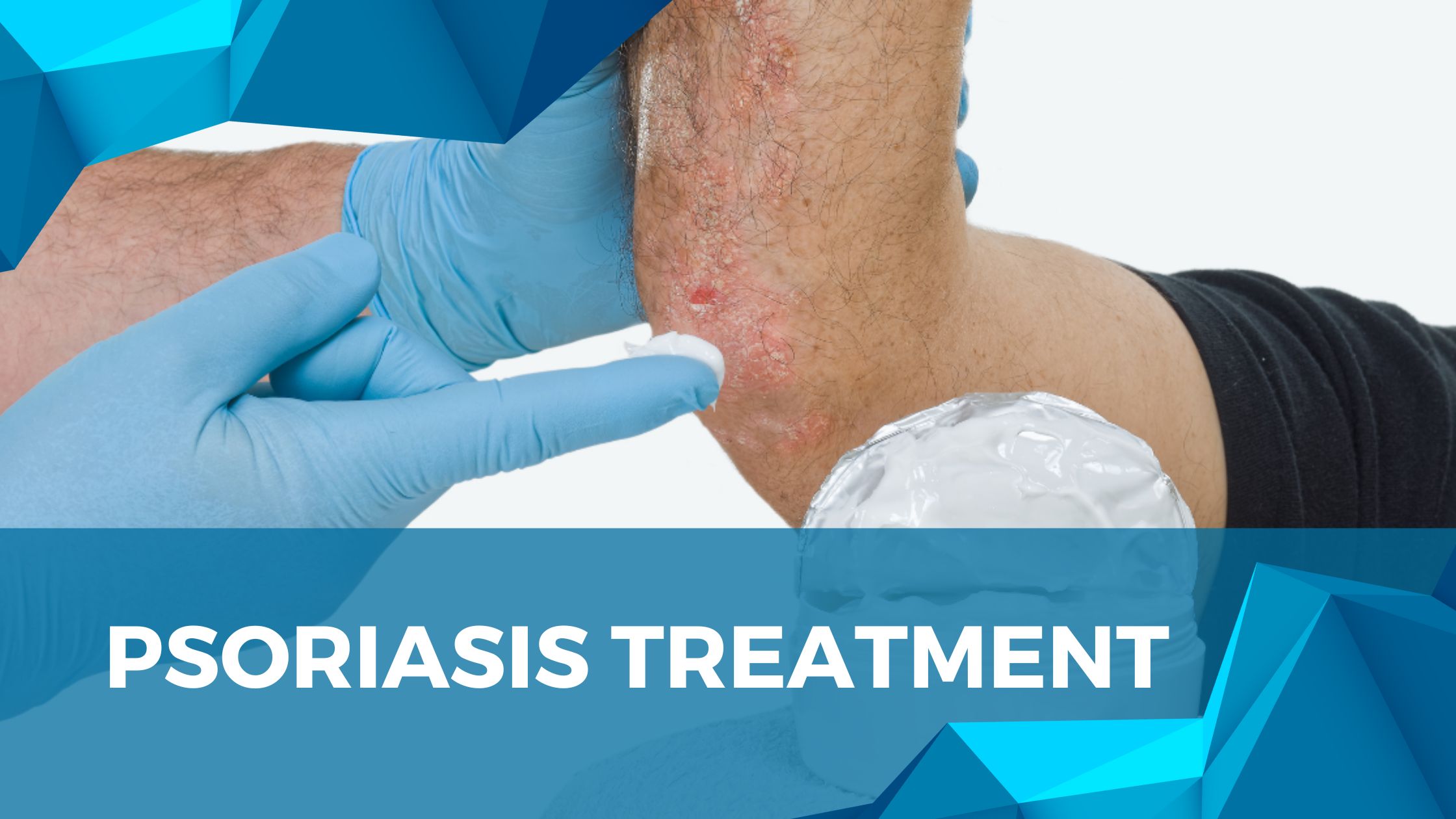 UVB Therapy For The Treatment Of Psoriasis